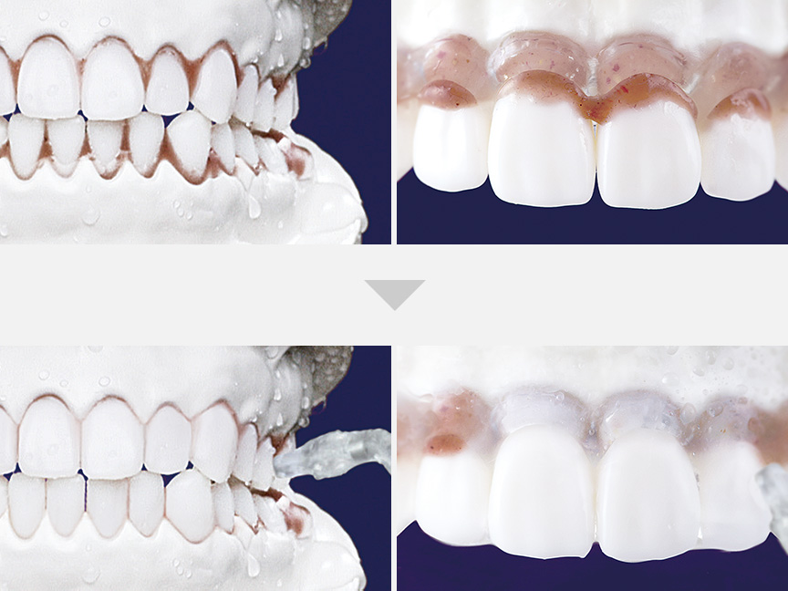 写真：歯磨き後に残った歯周ポケットの汚れや、歯間の汚れをしっかり洗い流すイメージ