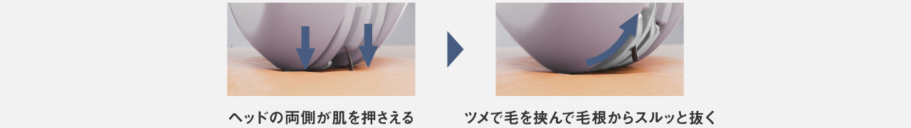 ヘッドの両側が肌を押さえる→ツメで毛を挟んで毛根からスルッと抜く