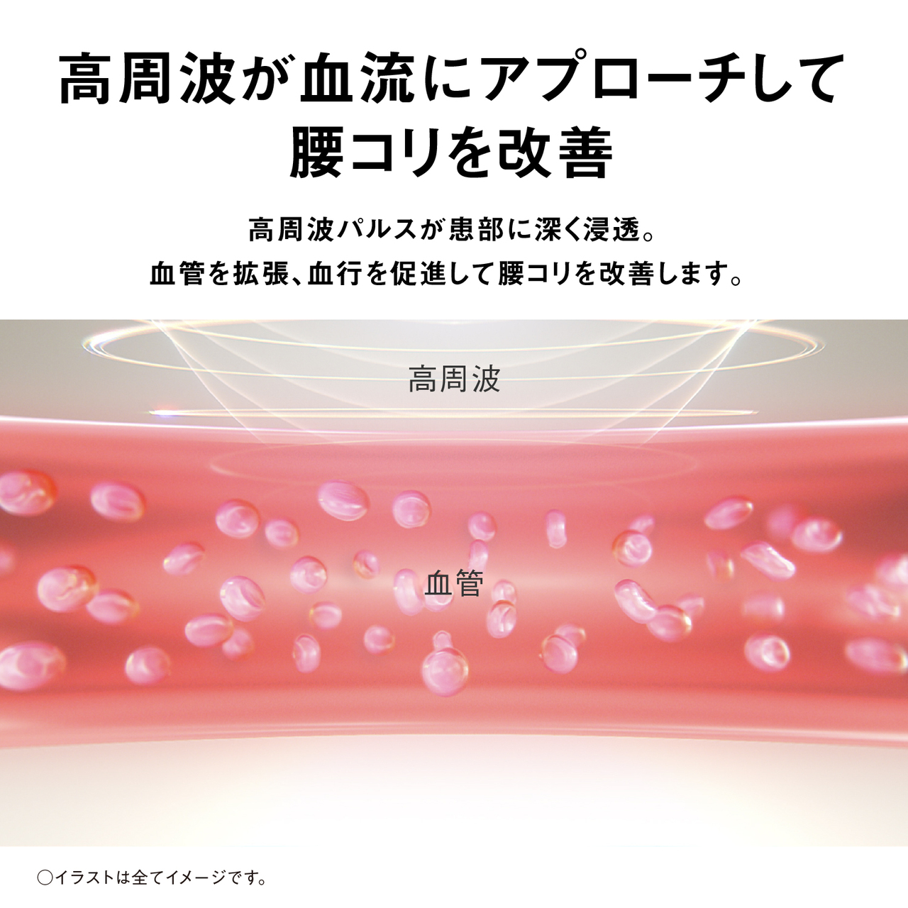 高周波が血流にアプローチして腰コリを改善 高周波パルスが患部に深く浸透。血管を拡張、血行を促進して腰コリを改善します。 高周波 血管 ○イラストは全てイメージです。