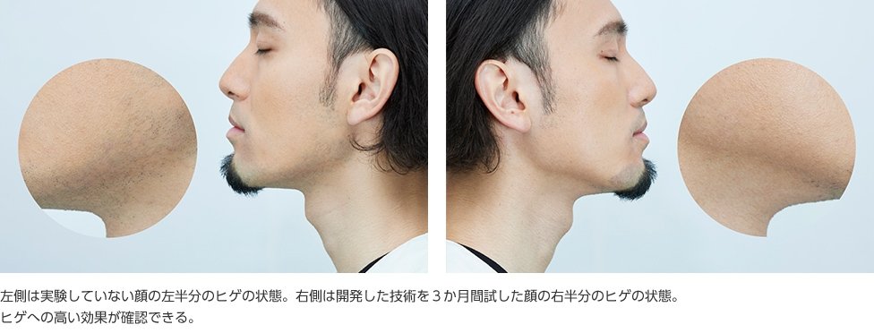 写真：功刀公太さん 左側は実験していない顔の左半分のヒゲの状態。右側は開発した技術を3か月間試した顔の右半分のヒゲの状態。ヒゲへの高い効果が確認できる。