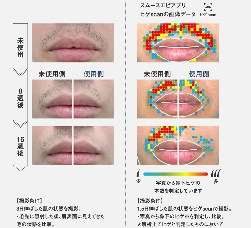 スムースエピアプリ ヒゲscanの画像データを用いた未使用と使用後の比較画像。 未使用、8週後、16週後を比較。 【撮影条件】 3日伸ばした肌の状態を撮影。毛先に照射した後、肌表面に見えてきた毛の状態を比較。 ・スムースエピアプリ ヒゲscanの画像データ比較画像 写真から鼻下ヒゲの本数を判定しています。 【撮影条件】 1.5日伸ばした肌の状態をヒゲscanで撮影。 ・写真から鼻下のヒゲ※を判定し、比較。 ★解析上でヒゲと判定したものにおいて