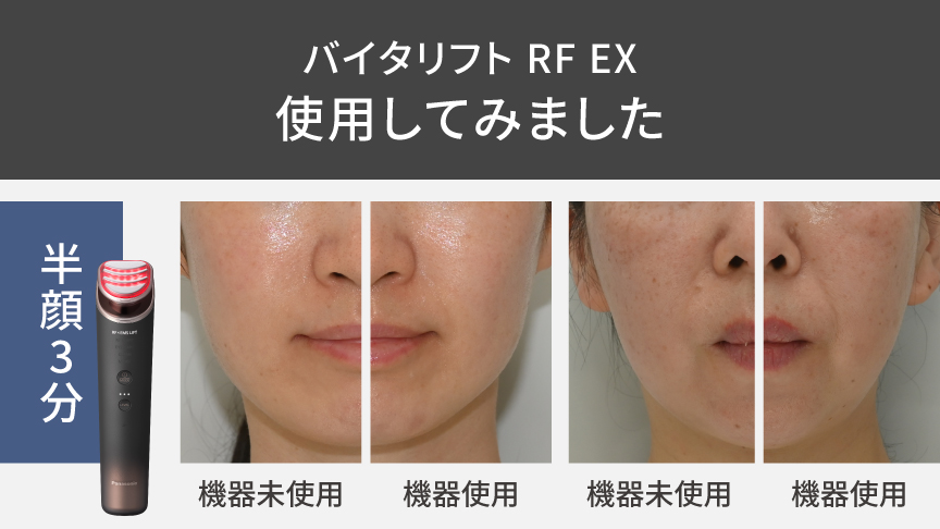 比較写真：バイタリフト RF EX使用してみました