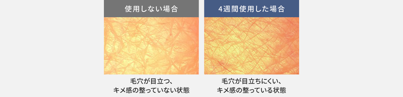 比較写真：使用しない場合（毛穴が目立つ、キメ感の整っていない状態）,4週間使用した場合（毛穴が目立ちにくい、キメ感の整っている状態）