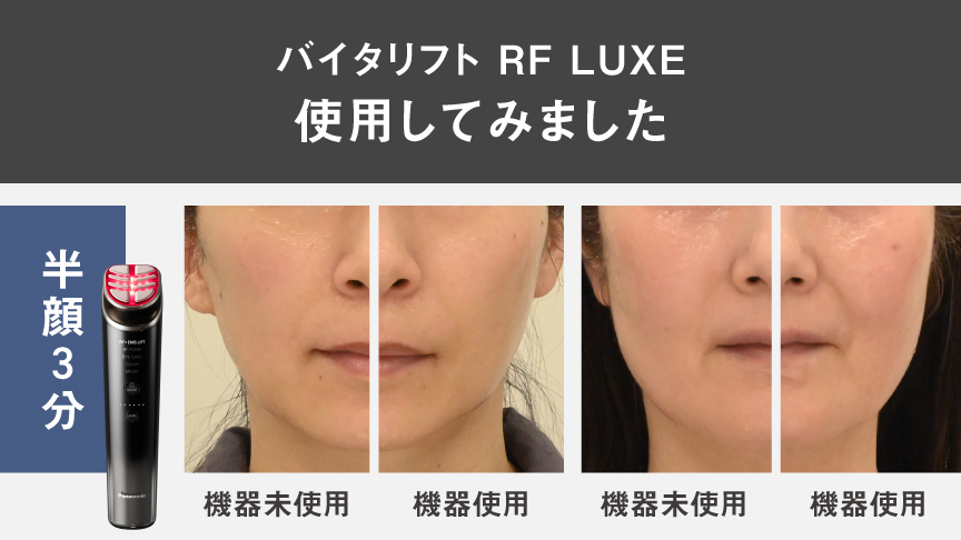 比較写真：バイタリフト RF LUXE 使用してみました