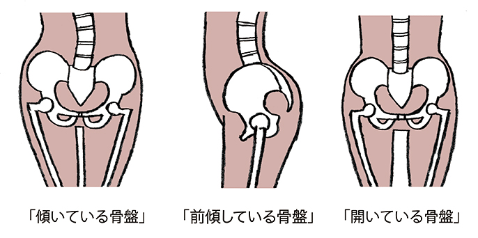 骨盤の状態を示したイラスト。左から「傾いている骨盤」、「前傾している骨盤」、「開いている骨盤」