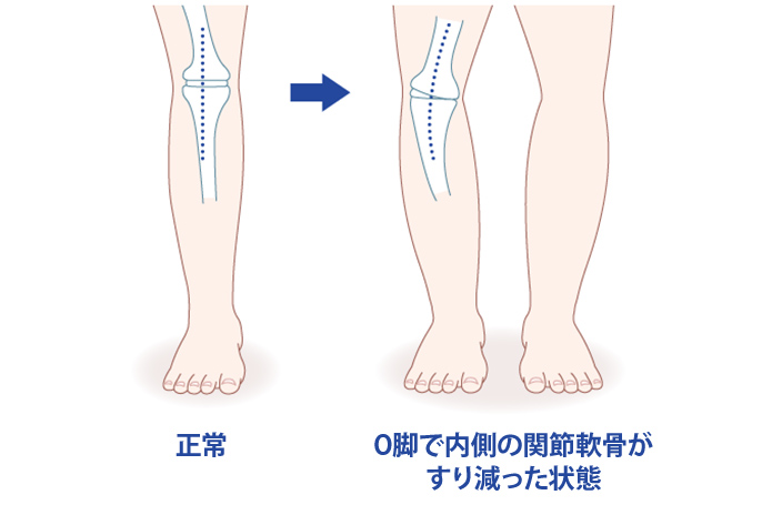 脚と内部の骨のイラスト：（左）正常→（右）O脚で内側の関節軟骨がすり減った状態
