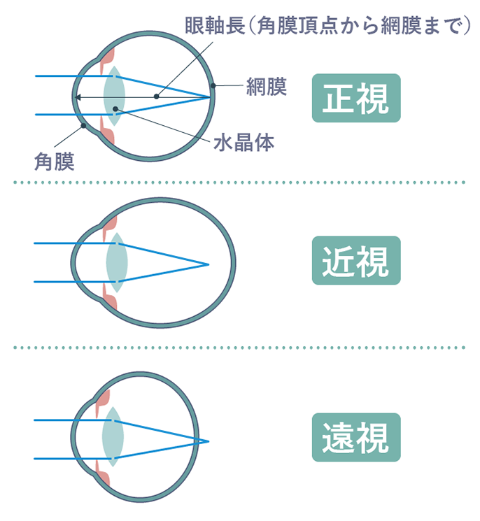 図：上から、正視　近視　遠視の、角膜　網膜　水晶体　眼軸長(角膜頂点から網膜まで)