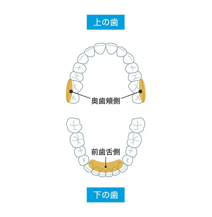 上の歯　奥歯頬側　下の歯　前歯舌側