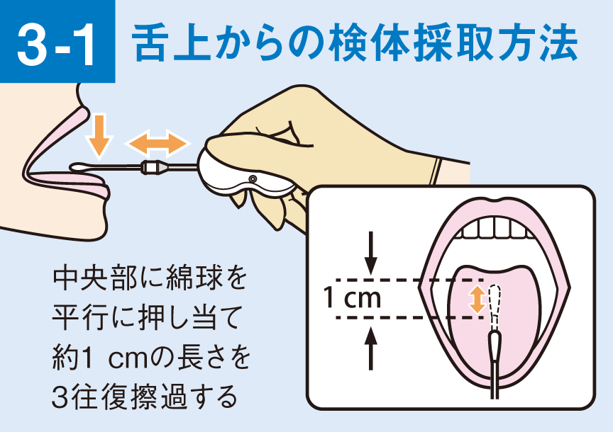 滅菌綿棒を定圧検体採取器具にセットして口腔内の舌上の検体を採取します