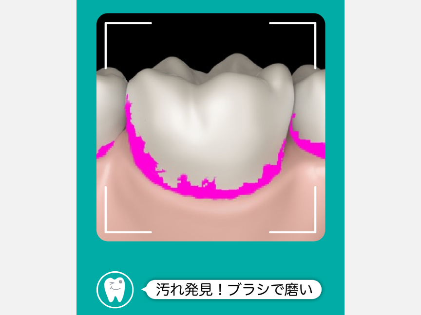 スマートフォン画面イメージ：歯垢はピンク色にハイライトされます