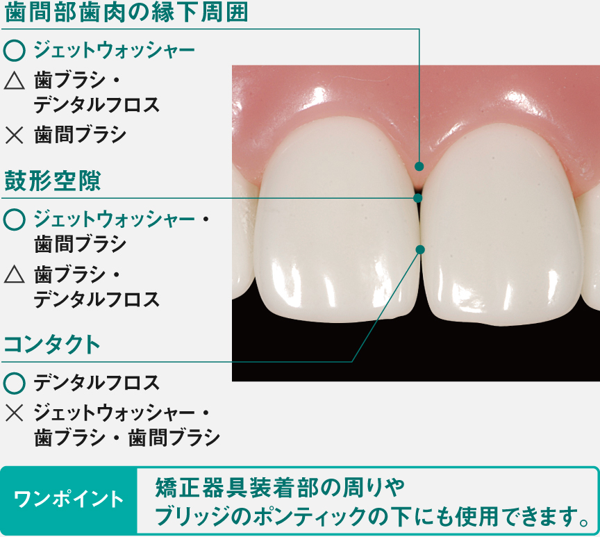 各ケアグッズの得意分野：歯間部歯肉の縁下周囲：○ジェットウォッシャー、△歯ブラシ・デンタルフロス、×歯間ブラシ　鼓形空隙：○ジェットウォッシャー・歯間ブラシ、△歯ブラシ・デンタルフロス　コンタクト：○デンタルフロス、×ジェットウォッシャー・歯ブラシ・歯間ブラシ　[ワンポイント]矯正装着の周りや、ブリッジのポンティックの下にも活用できます。