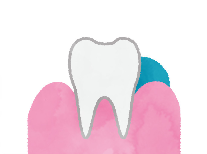 歯と歯ぐきの間