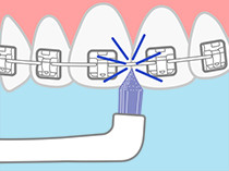 歯並びが悪い、矯正治療中で磨きにくい