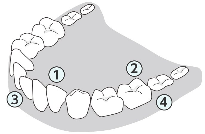 ①前歯　②奥歯　③歯並びの悪いところ　④奥歯の奥