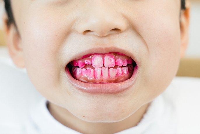 写真：赤い染めだし薬を付けたりょうたろうくんの歯のイメージ