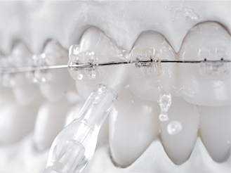 写真：歯列矯正器具のまわりに水流をあてている様子