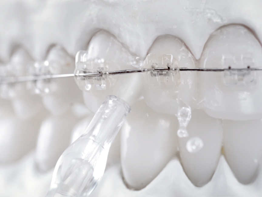 写真：歯列矯正器具のまわりに水流をあてている様子