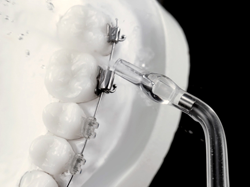 写真：歯間に水流をあてている様子