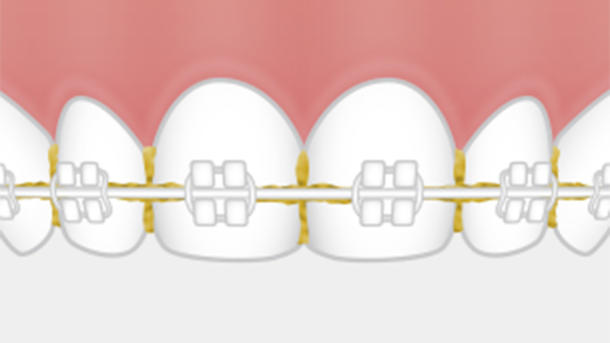 歯間やワイヤーの下に汚れが残っているイラスト