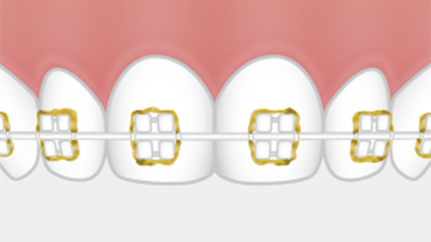 歯列矯正器具のまわりに汚れが残っているイラスト