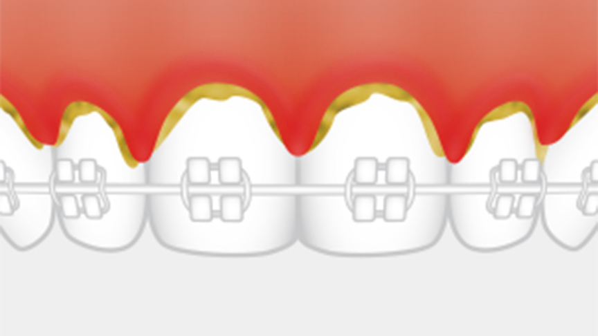 歯と歯ぐきの境目に汚れが残っているイラスト
