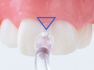 写真：歯の模型の、歯と歯の隙間、三角地帯を狙ってジェットウォッシャーをあてている様子