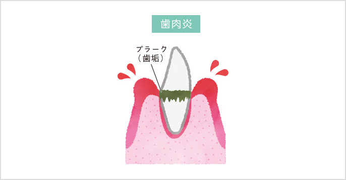 歯肉炎のイメージ