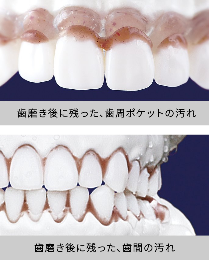写真：歯磨き後に残った、歯周ポケットの汚れ・歯磨き後に残った、歯間の汚れのイメージ