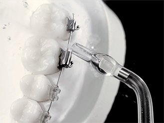 矯正ワイヤーのついた歯に水流ノズルを当てているクローズアップ画像