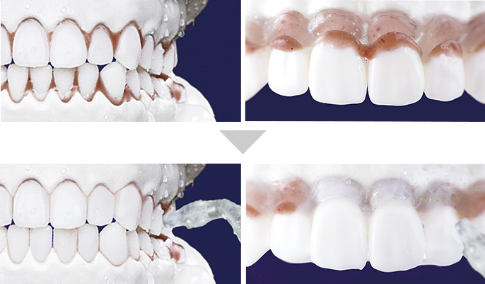 左側：歯磨き後に残った、歯間の汚れや歯周ポケットの汚れの様子 右側：ジェットウォッシャーで洗浄して除去した様子