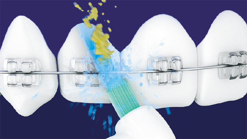 イメージ図：ブラシと水流が矯正器具周りの汚れを剥がす様子