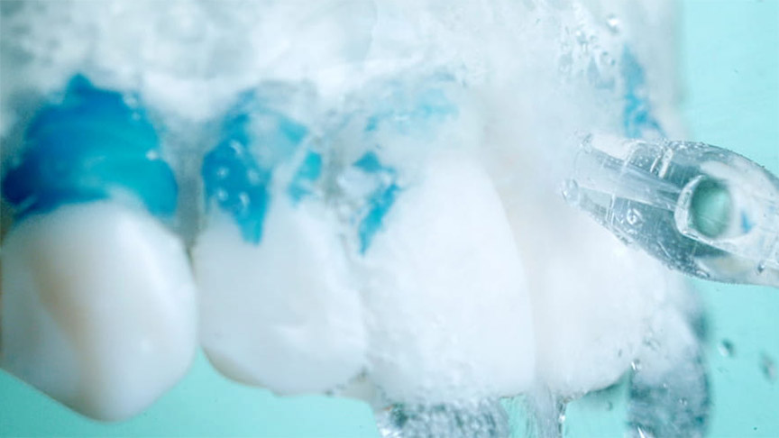 写真：ジェットウォッシャーが歯周ポケットの汚れを洗い流す様子