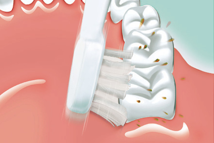 歯の汚れが、ブラシの音波振動で磨くことで、落ちている様子のイラスト