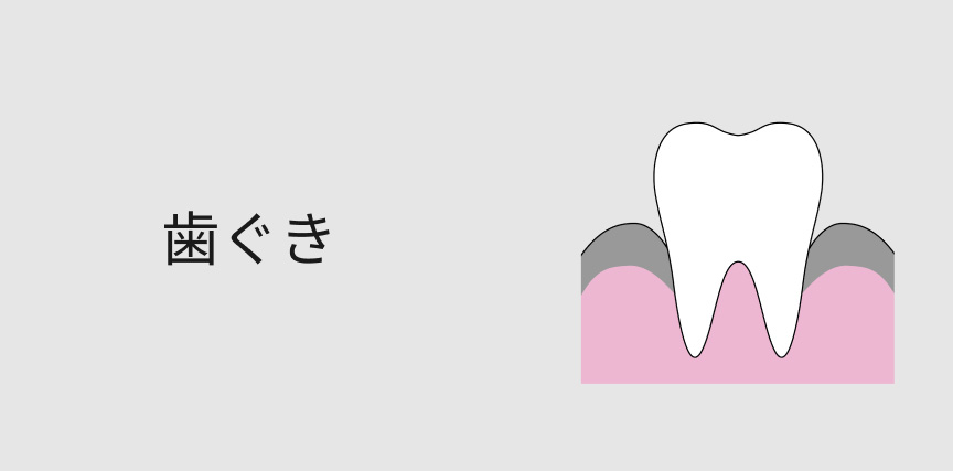 歯ぐき