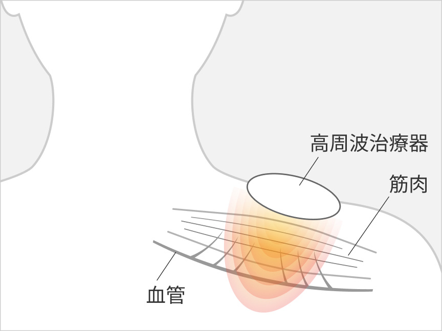 高周波治療器 血管 筋肉