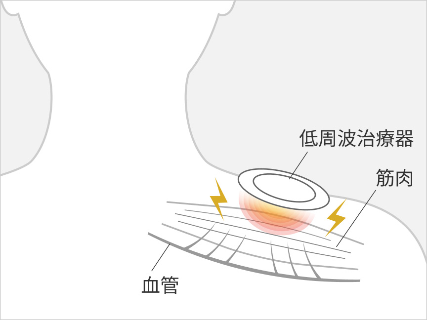低周波治療器 血管 筋肉