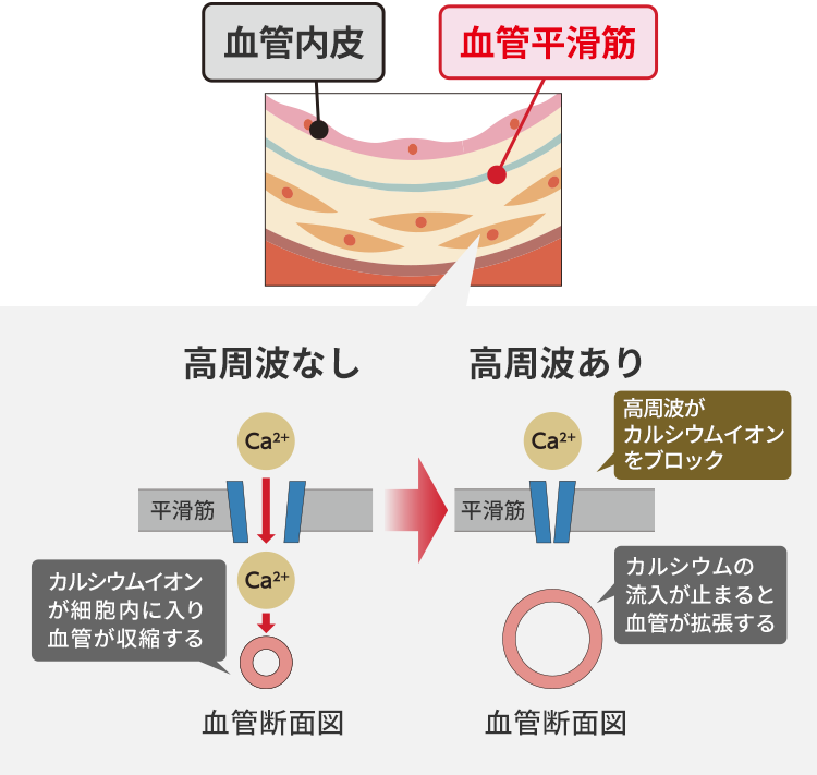 左側：血管内皮 血管平滑筋のイラスト 右側：高周波なし カルシウムイオンが細胞内に入り血管が収縮するイラスト、高周波あり 高周波がカルシウムイオンをブロック、カルシウムの流入が止まると血管が拡張する