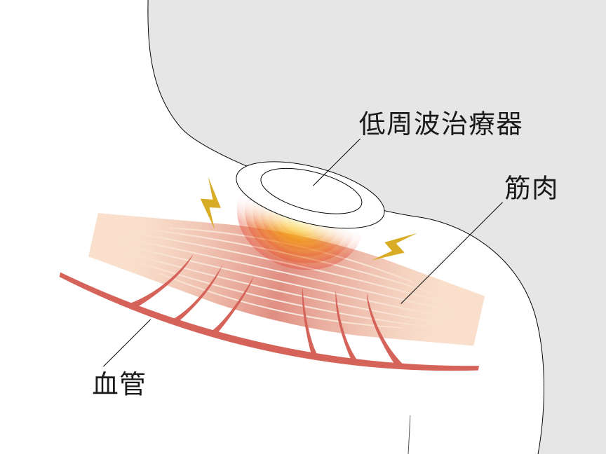 低周波治療器　筋肉に作用しているイメージ図