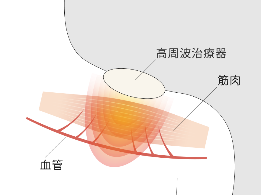 高周波治療器　血管に作用しているイメージ図