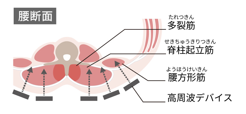 腰断面 多裂筋 脊柱起立筋 腰方形筋 高周波デバイス
