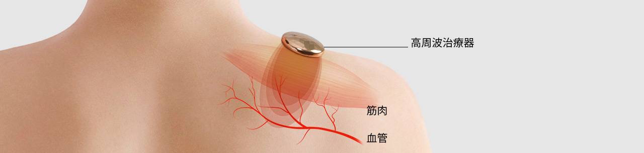 高周波治療器　筋肉　血管