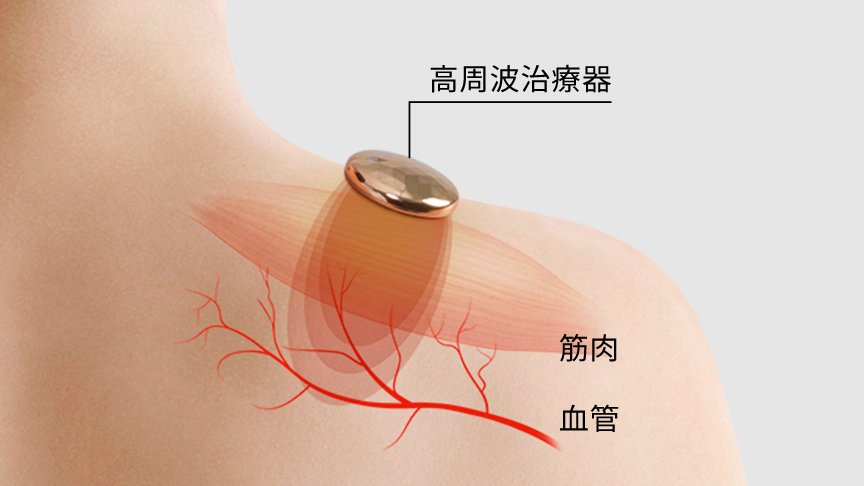 高周波治療器　筋肉　血管